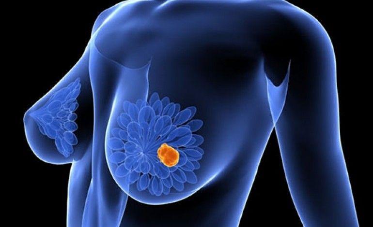 Nuevas tecnologías en diagnóstico de cáncer de mama permiten reducir el impacto de la quimioterapia