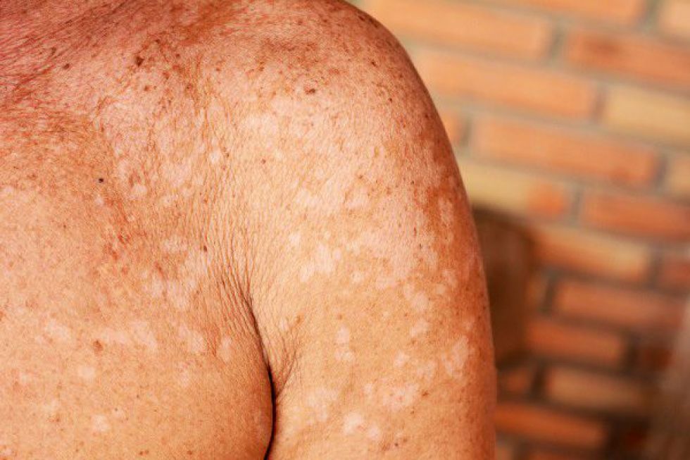 Exposición al sol puede generar daños irreversibles en la piel: IMSS