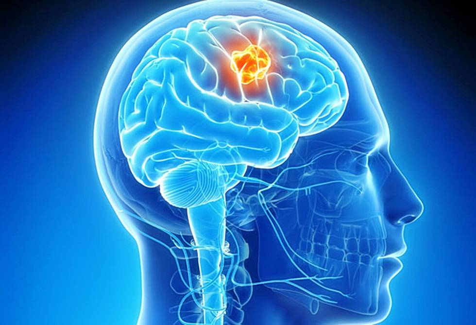 Malignos, la mayoría de tumores cerebrales en la edad adulta