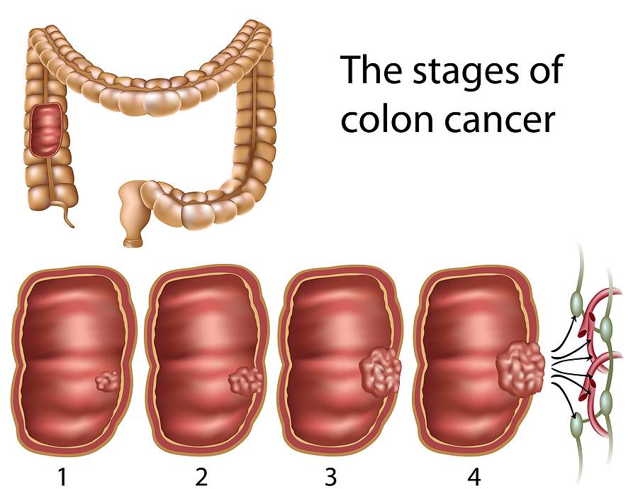     El cáncer de colon se presenta en México 10 antes que en otros países