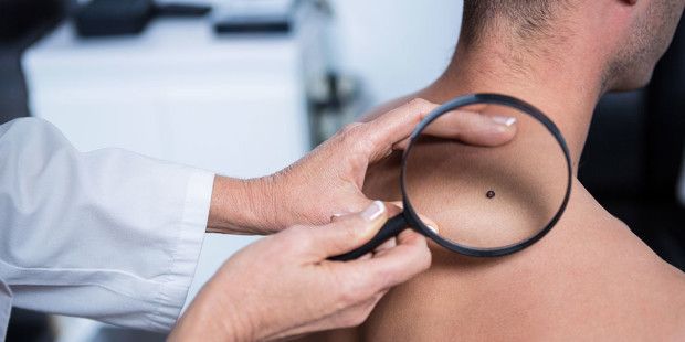 Cómo reconocer un melanoma
