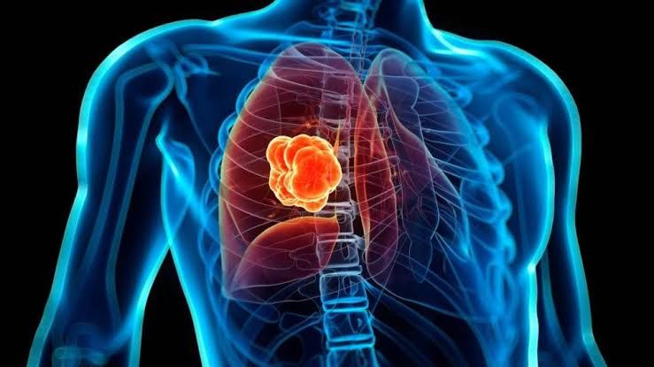Cáncer del pulmón genera más de un millón de muertes anuales