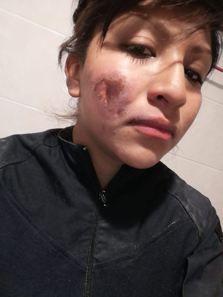 Esto dijo la mujer policía que fue quemada de la cara por manifestantes 