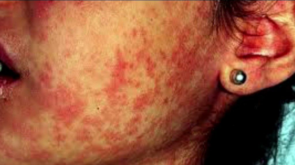 Salud del Edoméx informa que paciente de sarampión ya se encuentra asintomática