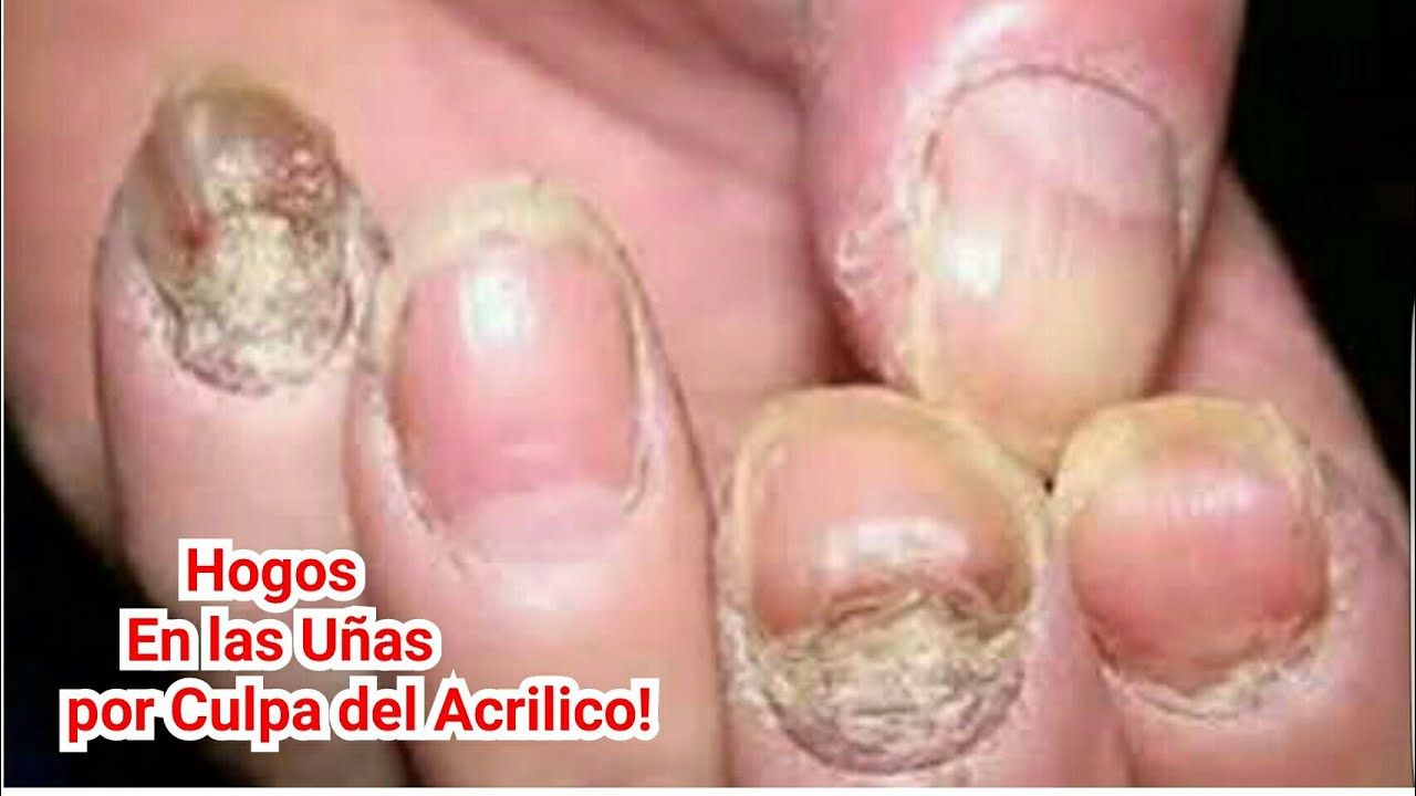 SS advierte sobre los daños a la salud por usar uñas acrilicas