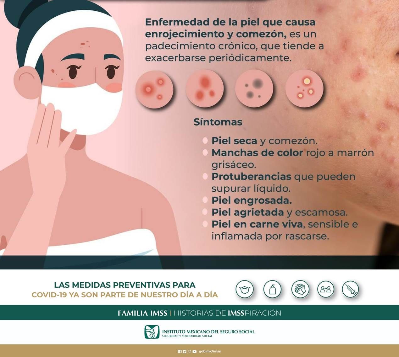 La dermatitis atópica caracterizada por comezón, salpullido e inflamación en la piel