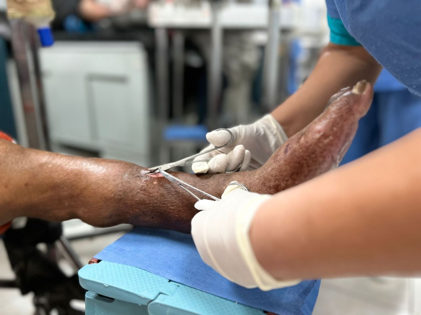 Ecatepec rescata clínica especializada en pie diabético; logran sanar 90% de pacientes
